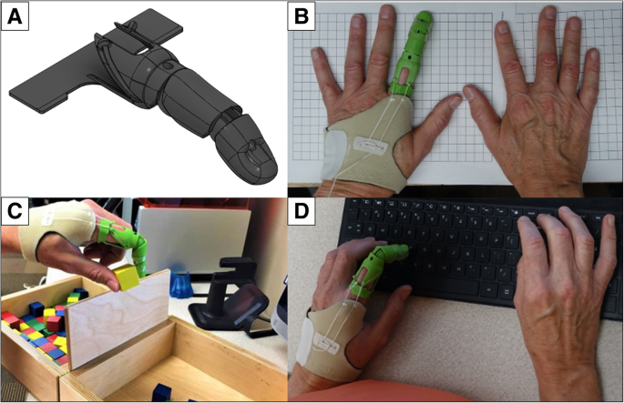 3D printing prosthetics: how 3D printing is helping millions of people around the world