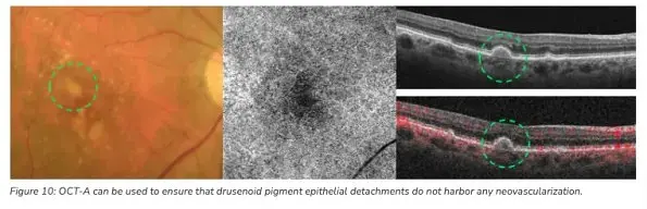 The Benefits of OCT Angiography for Ocular Disease Diagnosis