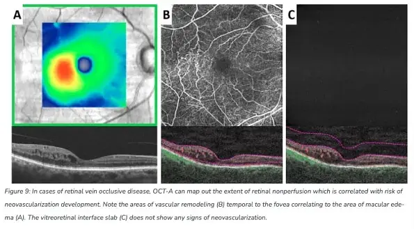 The Benefits of OCT Angiography for Ocular Disease Diagnosis