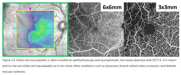 The Benefits of OCT Angiography for Ocular Disease Diagnosis