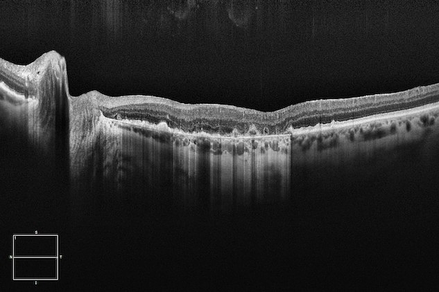 OCT has become indispensable. ZEISS OCT