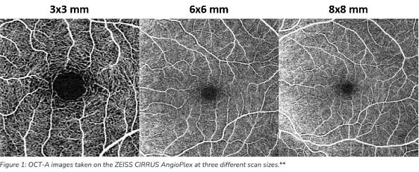 The Benefits of OCT Angiography for Ocular Disease Diagnosis