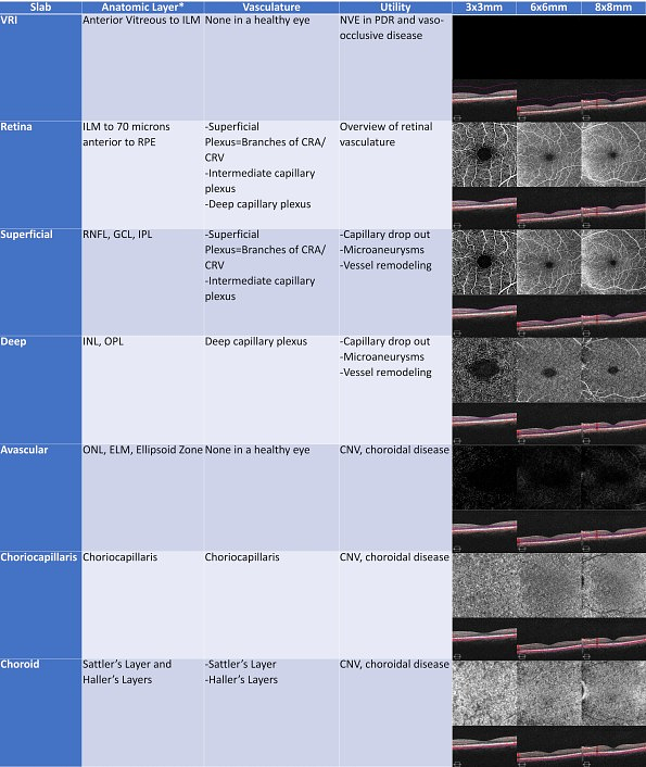 The Benefits of OCT Angiography for Ocular Disease Diagnosis