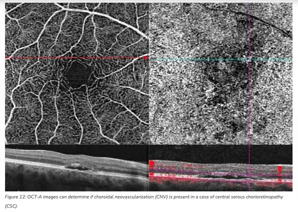 The Benefits of OCT Angiography for Ocular Disease Diagnosis