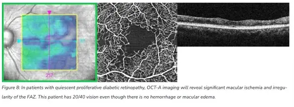 The Benefits of OCT Angiography for Ocular Disease Diagnosis