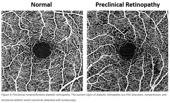 The Benefits of OCT Angiography for Ocular Disease Diagnosis