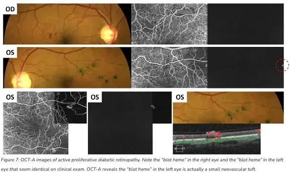 The Benefits of OCT Angiography for Ocular Disease Diagnosis