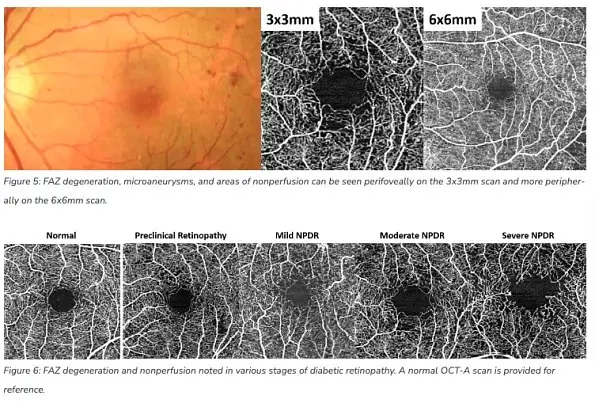 The Benefits of OCT Angiography for Ocular Disease Diagnosis