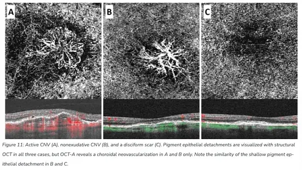 The Benefits of OCT Angiography for Ocular Disease Diagnosis